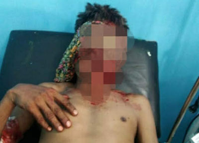 Diduga Diserang Beruang, Pasutri di Kuansing Mengalami Luka Robek Serius